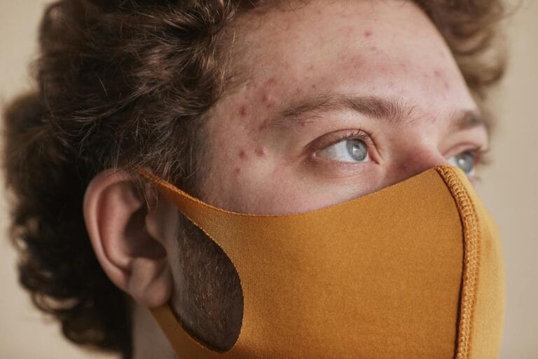 Detailed close-up of a man wearing a face mask, highlighting his acne and blue eyes. bakteri penyebab jerawat. Acne-Causing Bacteria