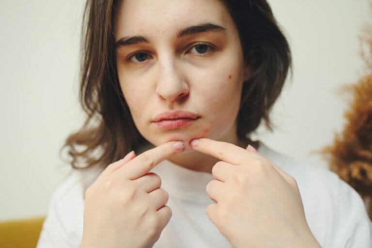 Close-up of a woman with acne touching her face, highlighting skin care concerns. acne patch.