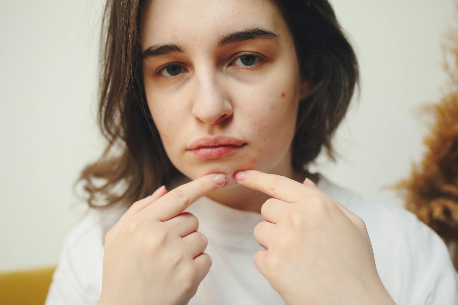 Close-up of a woman with acne touching her face, highlighting skin care concerns. acne patch.