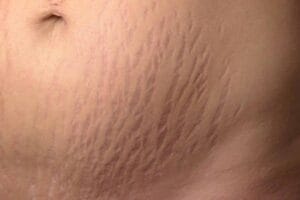 Stretch Mark