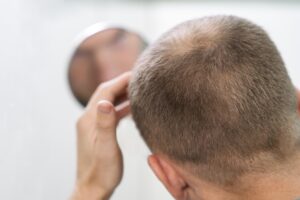 Kerontokan dan kebotakan perlu diketahui penyebab dan solusinya termasuk hasil uji efikasi produk perawatan rambut.