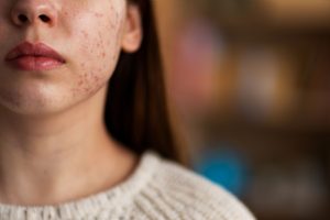 anti acne skincare products, microbilogical testing in laboratory