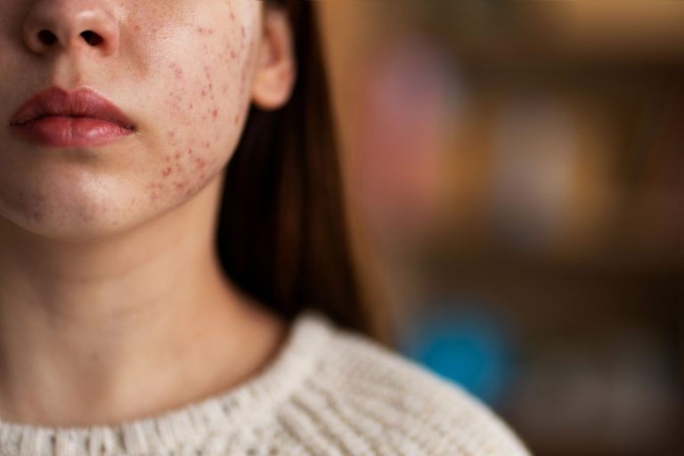 anti acne skincare products, microbilogical testing in laboratory