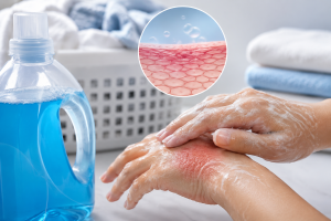 Skin Exposure Risks of Liquid Detergents and the Importance of Dermal Toxicity Testing