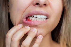 Porphyromonas gingivalis: Understanding Its Role as a Keystone Pathogen and How It Is Identified