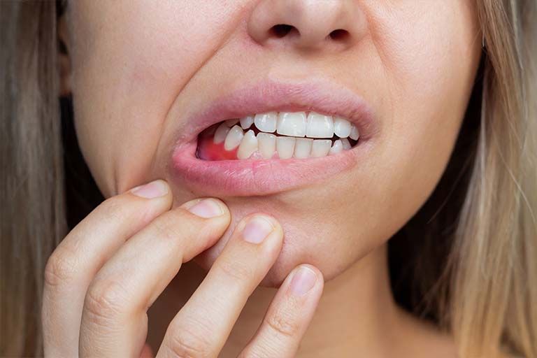 Porphyromonas gingivalis: Understanding Its Role as a Keystone Pathogen and How It Is Identified